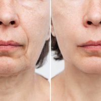Rejuvenating non-surgical skin resurfacing treatments